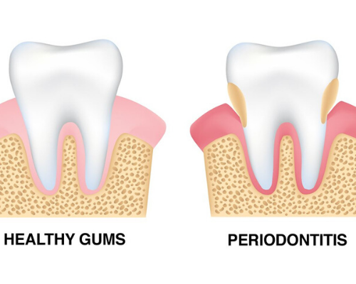 Periodontal Treatment