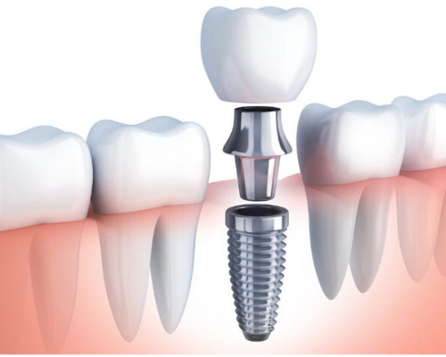 Dental Implants