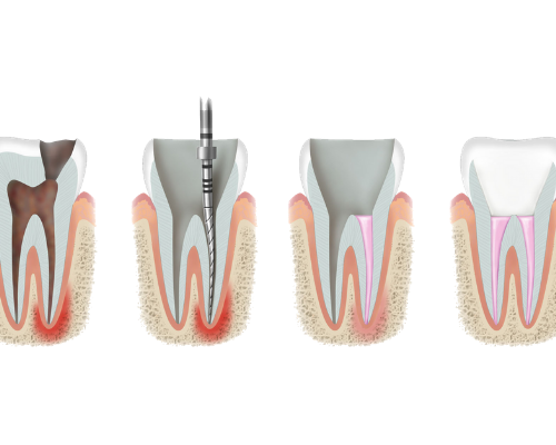 Root Canal