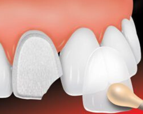 Veneers