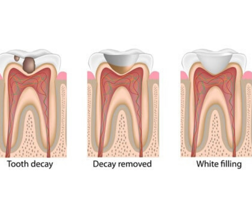 Fillings