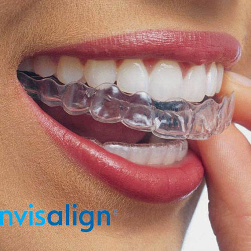 Invisalign
